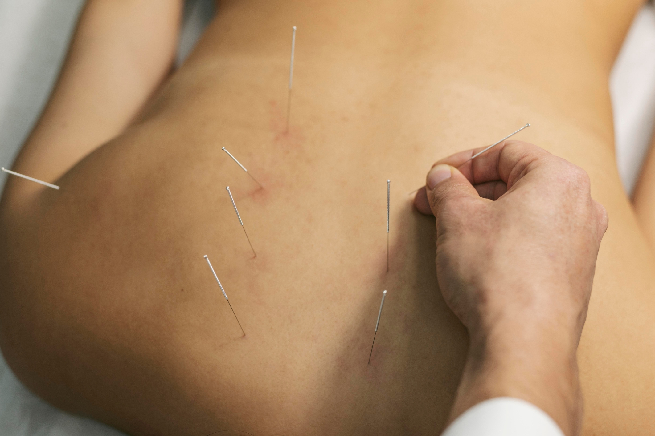Dry Needling: How It Works and What It Treats