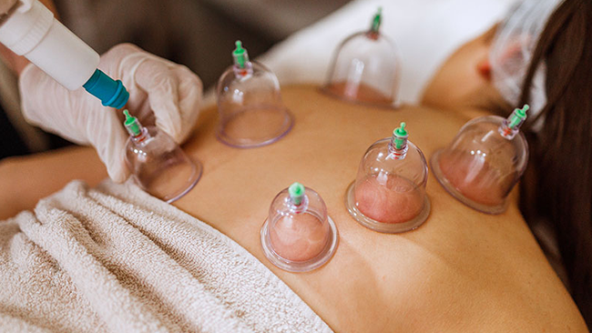 Cupping Therapy Treatment