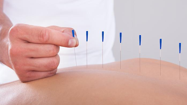Dry Needling Therapy