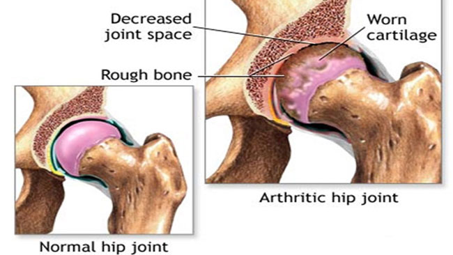 HIP ARTHRITIS