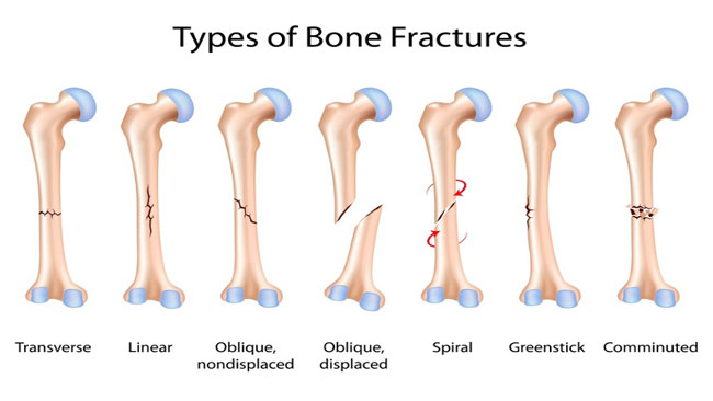FRACTURES