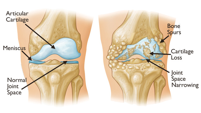 KNEE ARTHRITIS